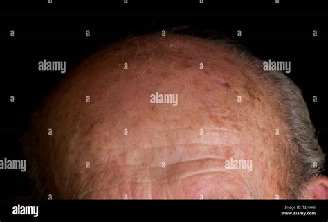 Sun Skin Damage High Resolution Stock Photography And Images Alamy