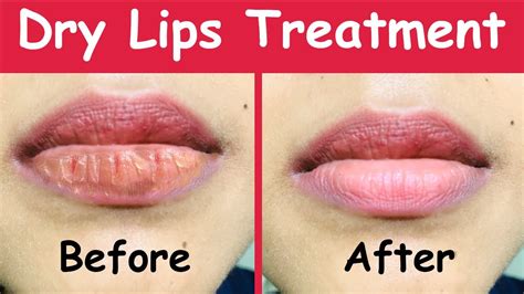 Best Natural Dry Lips Treatment Dry Lips Treatment At Home With Magical Results Youtube