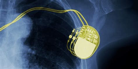 Mri With Pacemaker Is It Safe American Health Imaging