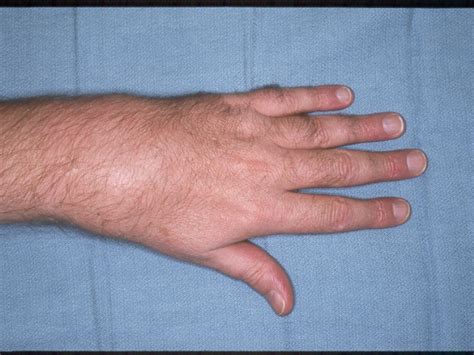 Wrist Tendonitis Swelling