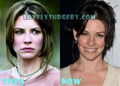 Evangeline Lilly Plastic Surgery Before And After Photos Lovely