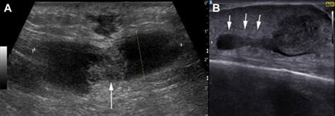Primary Care Management Of Skin Abscesses Guided By Ultrasound The