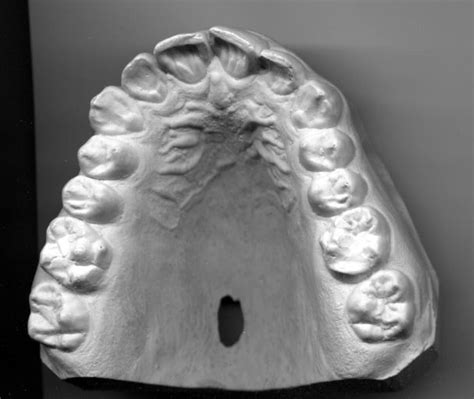 Dentition Wikidoc