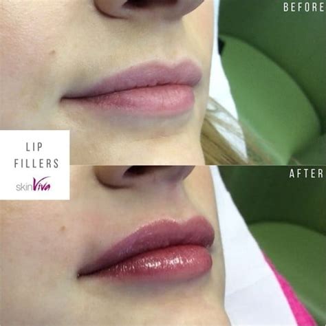 Lip Fillers And Lip Enhancement Skinviva Manchester