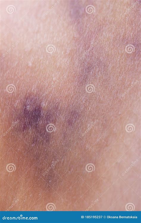 Hematoma On The Skin Of The Legs Stock Image Image Of Stain Blue
