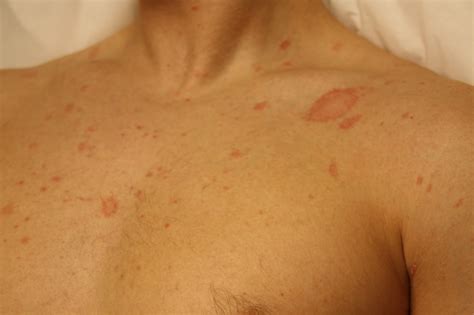 Skin Disease Types Pityriasis Rosea Skin Disease Type