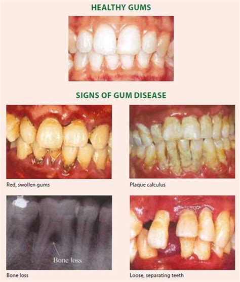 Gum Disease