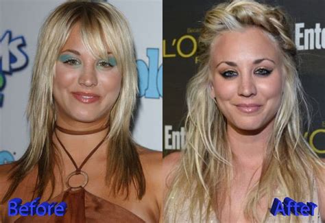 Kaley Cuoco Before After Plastic Surgery
