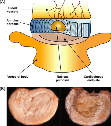Intervertebral Disc Anatomy
