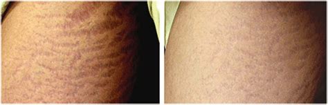 Stretch Mark Treatment Solihull Medical Cosmetic Clinic
