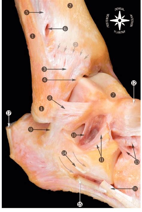 Acute excessive inversion, df and inversion, torn retinaculum. Anatomic dissection of the lateral region of the foot and ...