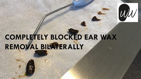 534 Completely Blocked Ear Wax Removal Bilaterally Narrow Ears