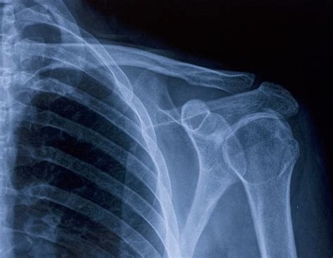 The Facts About Clavicle Fractures In Newborns Scott Goodwin Law