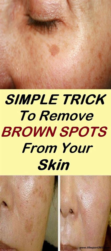 Pin By Sevastianevdokimov On Beauty Brown Spots On Face Spots On