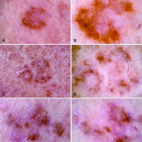 Set Of Images Of Pigmented Basal Cell Carcinoma Clinical Overview A
