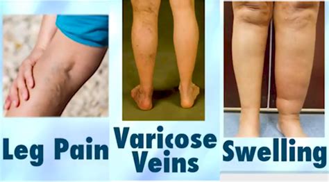 Leg Pain Swelling Or Varicose Veins Primarily In The Left