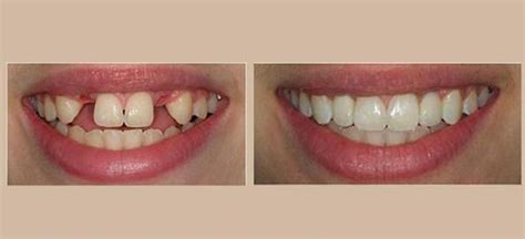 Types Of Partial Dentures Maritza O Jenkins Dmd General Dentist