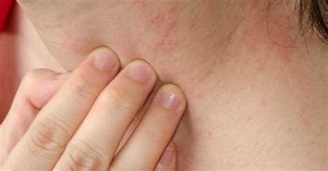 Itchy Rash Skin Rash Symptoms Causes Treatments Diagnosis