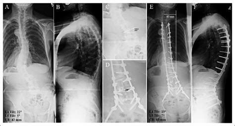 Preoperative Standing Anteroposterior A And Lateral B Radiographs