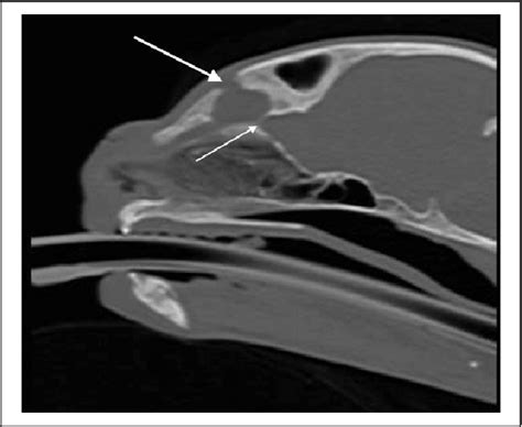 Figure 2 From Nasal Dermoid Cyst With Intracranial Extension In A Cat