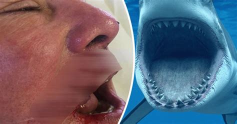 Horrific Pictures Shows Dentists Savaged Face After Monster Shark Hit