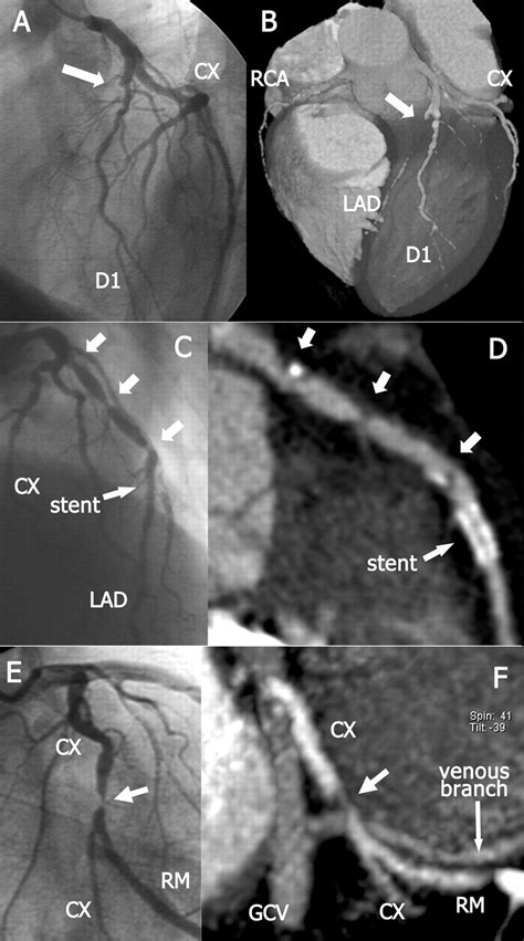 Reliable Noninvasive Coronary Angiography With Fast Submillimeter