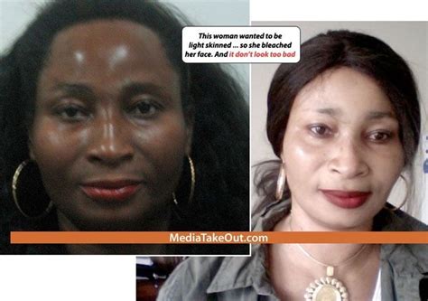 Pin On Skin Bleaching Before And After