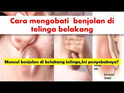 Pada beberapa kasus, benjolan di telinga bukanlah sesuatu yang berbahaya. Cara mengobati benjolan di telinga belakang | Muncul ...