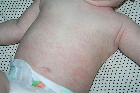 Viral Rashes On Babies