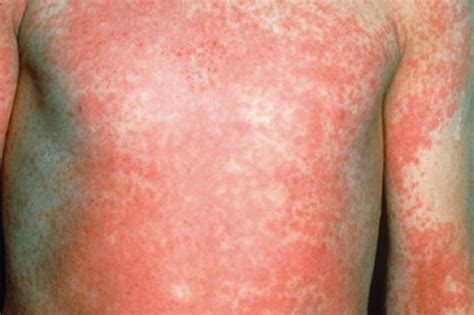 Scarlet Fever Causes Symptoms Long Term Effects Treatment