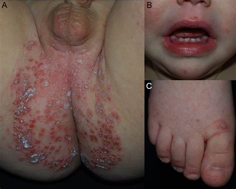 Hand Foot Mouth Disease Ira Childrens Clinic