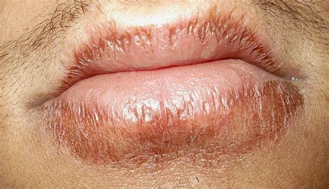 Sores On Lips Cracks Blisters Lumps Causes