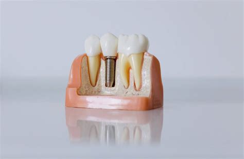 Cheapest Dental Implants Abroad Medica Smile