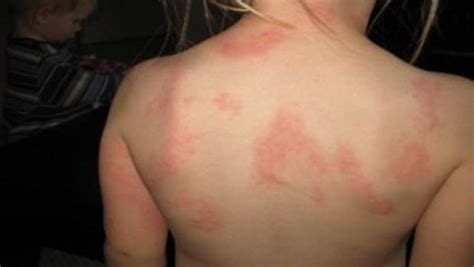 Top 33 Different Types Of Skin Infections In Children
