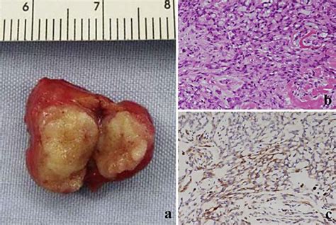 A Gross Appearance Of The Tumor B Microscopic Appearance Of The Tumor