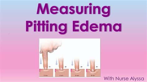 How To Measure Pitting Edema YouTube