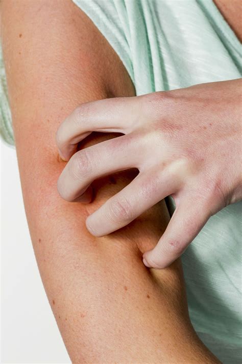 Rash Caused by Lamictal May Be a Sign of Drug Induced Hypersensitivity