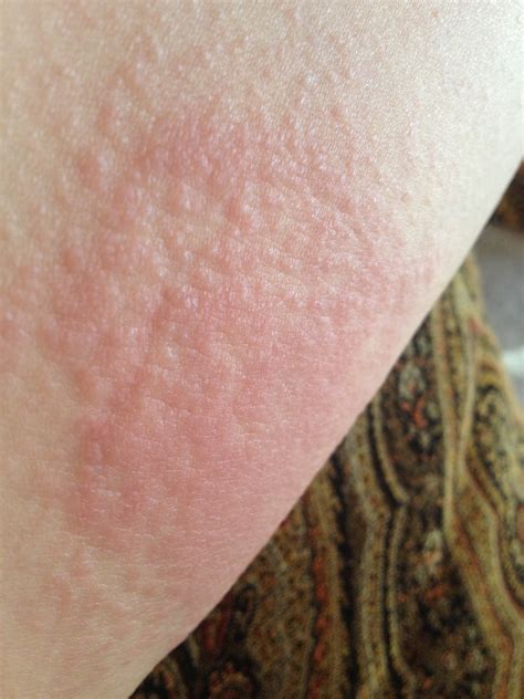 Itching (pruritus) is an unpleasant sensation where the skin signals a reflex response outbreaks of rashes that are itchy, red, spots or bumps on the skin are very common and have pityriasis rosea on stomach. Itchy rash on my arms, legs, stomach