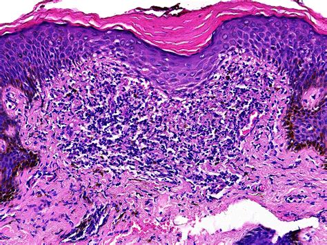 Pathology Outlines Lichen Nitidus