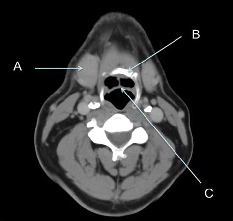 Axial Computed Tomography Image Through The Neck Soft Tissue Windows