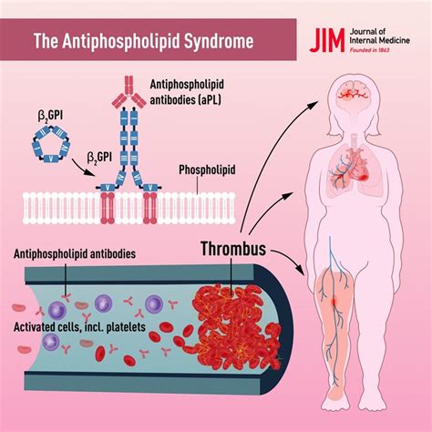 The Antiphospholipid Syndrome Often Overlooked Cause Of Vascular