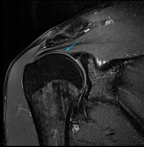 Mri Shoulder Normal Supraspinatus Tendon 6 Mri At Melbourne Radiology