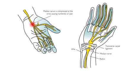 Carpal Tunnel Syndrome Cts Stuart Hinds Performance Therapy
