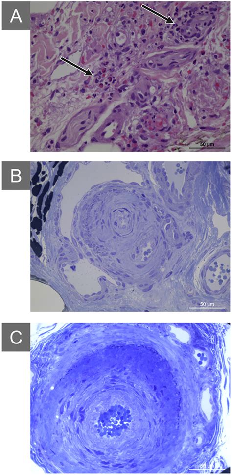 Eosinophilic Granulomatosis With Polyangiitis A Skin Histology Hande