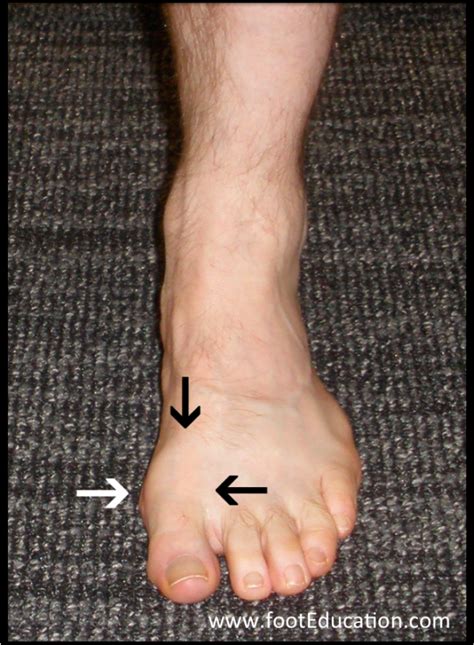 Hallux Rigidus Big Toe Arthritis Footeducation