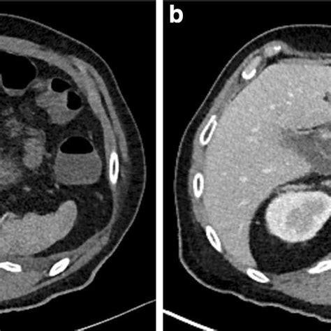 Computed Tomography Scans Of The Pancreas A Hypervascular Lesion In