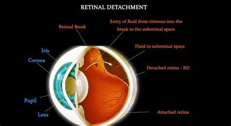 Eye Problems Myopiaretinal Breaksretinal Detachment