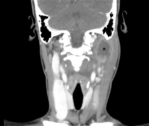 Coronal Computed Tomography Of The Neck With Contrast Demonstrating A