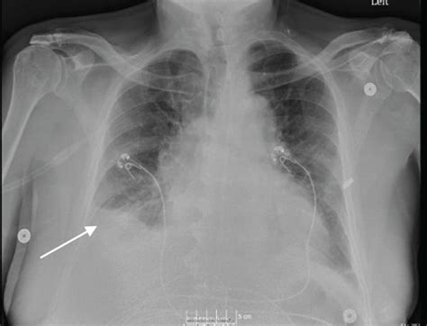A Chest Radiograph Showing Small Right Pleural Effusion On Admission