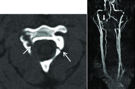 39 Vertebral Artery Injury A Axial Ct Image Shows Fra Vrogue Co
